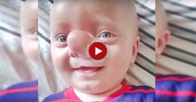 Real Life Pinocchio Baby Born With His Brain Growing Into NOSE Due To His Skull Not Forming Properly