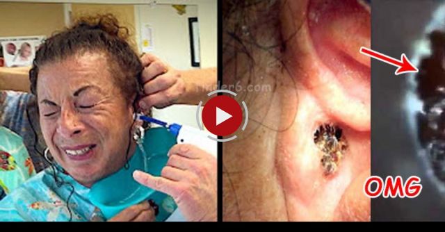 Massive Earwax Removal!