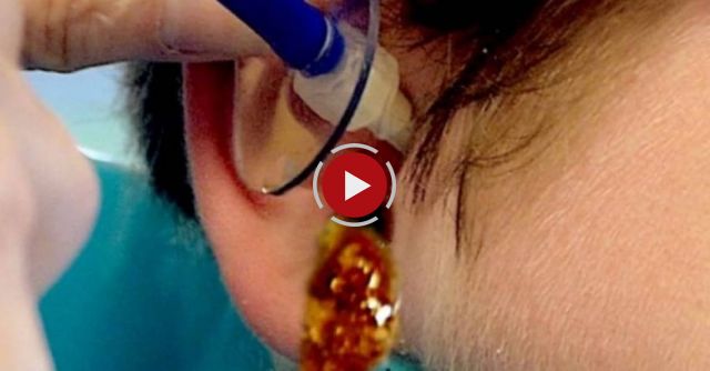 He Had Issues Hearing For Months. What A Doctor Gets To Ooze Out Of His Ear? SO DISTURBING.