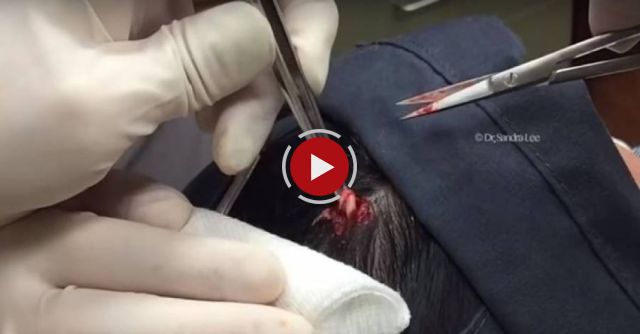 Dr Pimple Popper Pilar Cyst Spurt