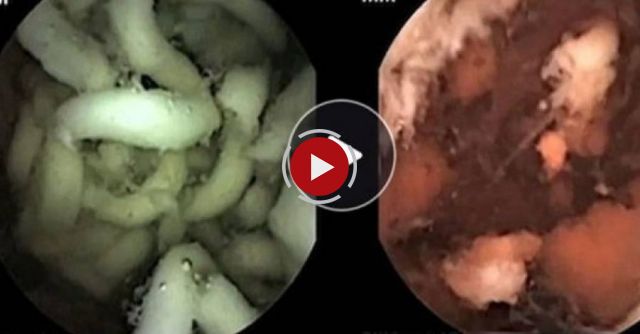 Inside Stomach Ramen Noodle Digestion Goes Viral