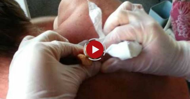 30 Year Old Cyst Explosion