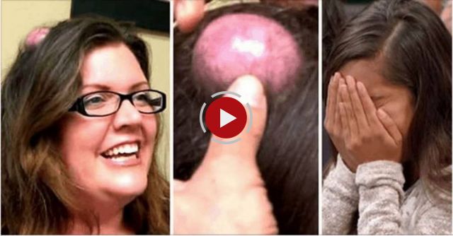 Woman’s 20-Year-Old Cyst Finally Gets Popped