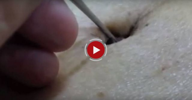 Giant Blackhead Removal!